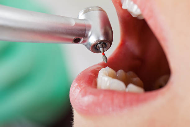 Best Emergency Dental Care for Abscessed Tooth in East Palatka, FL